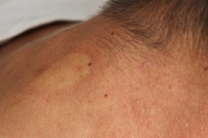 joven chikungunya 03