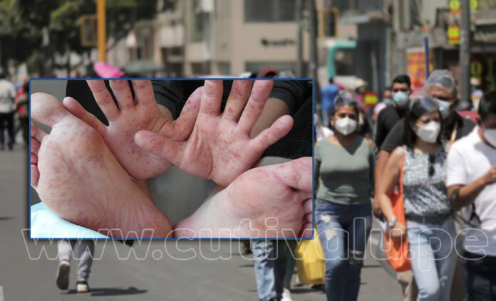 Coxsackie - enfermanos manos pies y boca