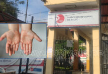 Piura: Confirman primer caso de viruela del mono en una mujer de 24 años