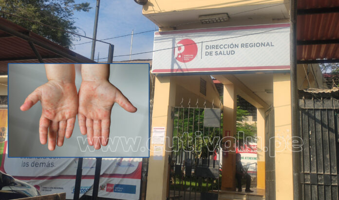 DIRESA PIURA - viruela mono