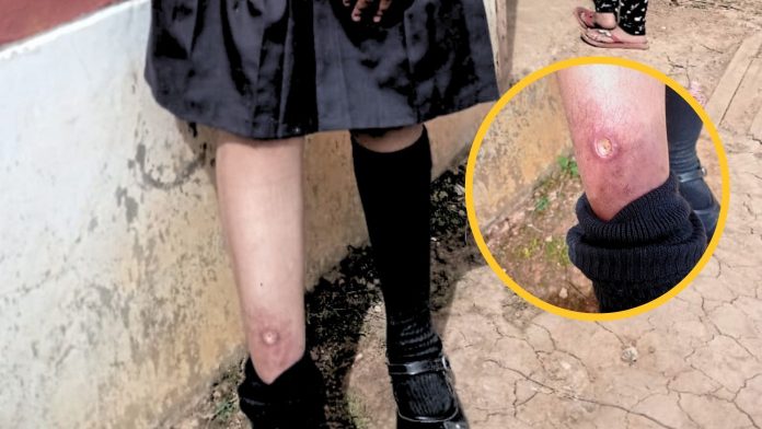 Ayabaca: reportan caso de UTA en Sapillica y no hay medicina para el tratamiento