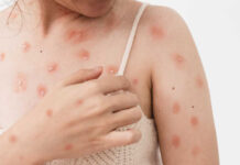 Viruela del mono. Difusión