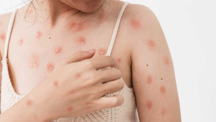 Viruela del mono. Difusión