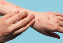 Piura: autoridades identifican dos casos sospechosos de viruela del mono