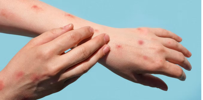 Piura: autoridades identifican dos casos sospechosos de viruela del mono