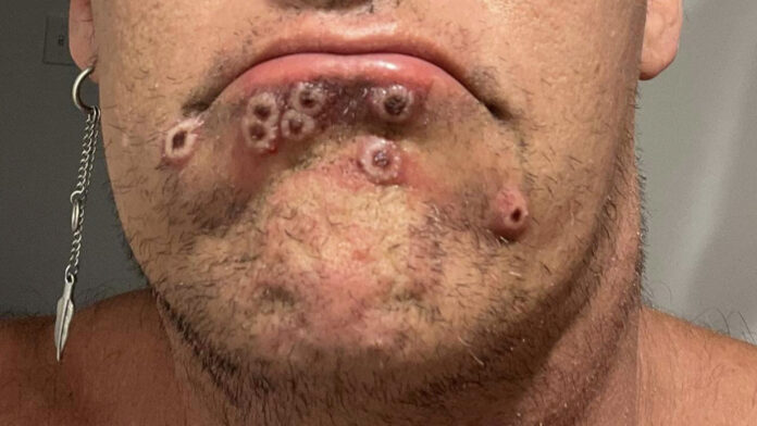 Reportan primer paciente con viruela del mono en Piura, después de dos años sin casos