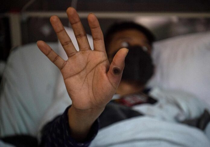 viruela del mono Emergencia mundial por la viruela del mono: Piura registra 2 casos y "no hay que tomarlo a la ligera", afirma especialista